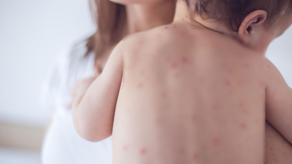 ХӨСҮТ: Улаанбурхан өвчний  тохиолдол 3547 боллоо